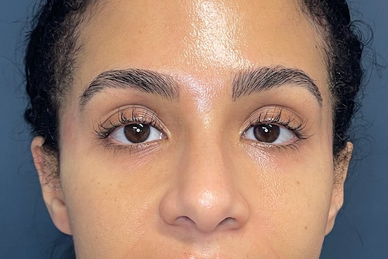 Facial Fillers Before & After Gallery - Patient 843575 - Image 2