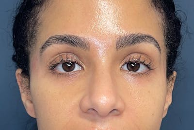 Facial Fillers Before & After Gallery - Patient 843575 - Image 2