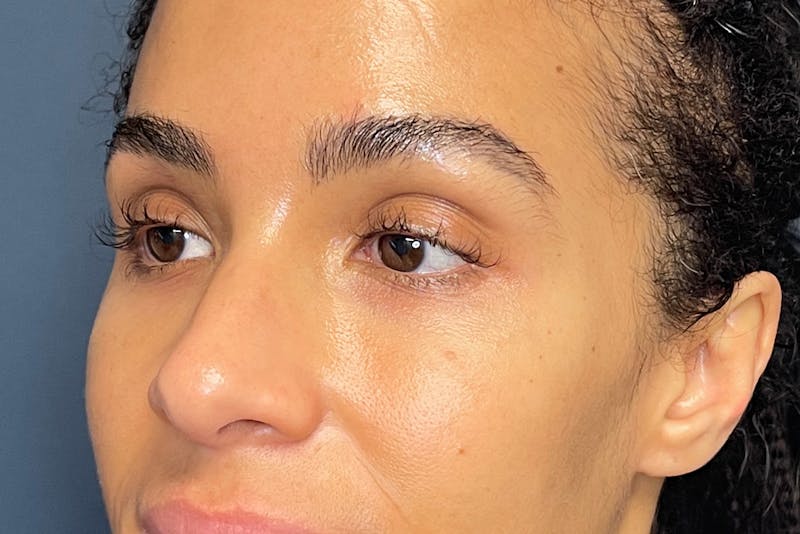 Facial Fillers Before & After Gallery - Patient 843575 - Image 3