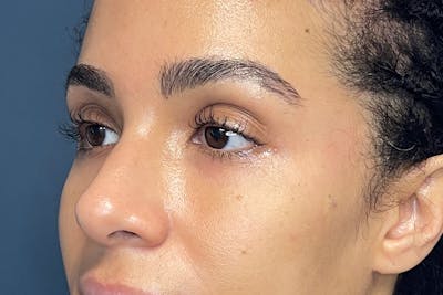 Facial Fillers Before & After Gallery - Patient 843575 - Image 4