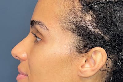 Facial Fillers Before & After Gallery - Patient 843575 - Image 5