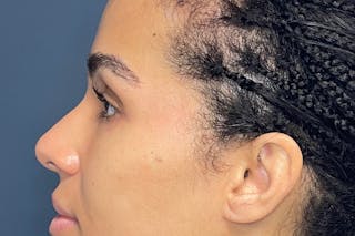 Facial Fillers Before & After Gallery - Patient 843575 - Image 6