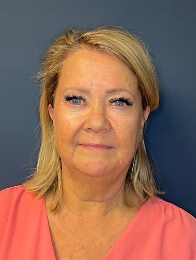 Facial Fillers Before & After Gallery - Patient 380456 - Image 1