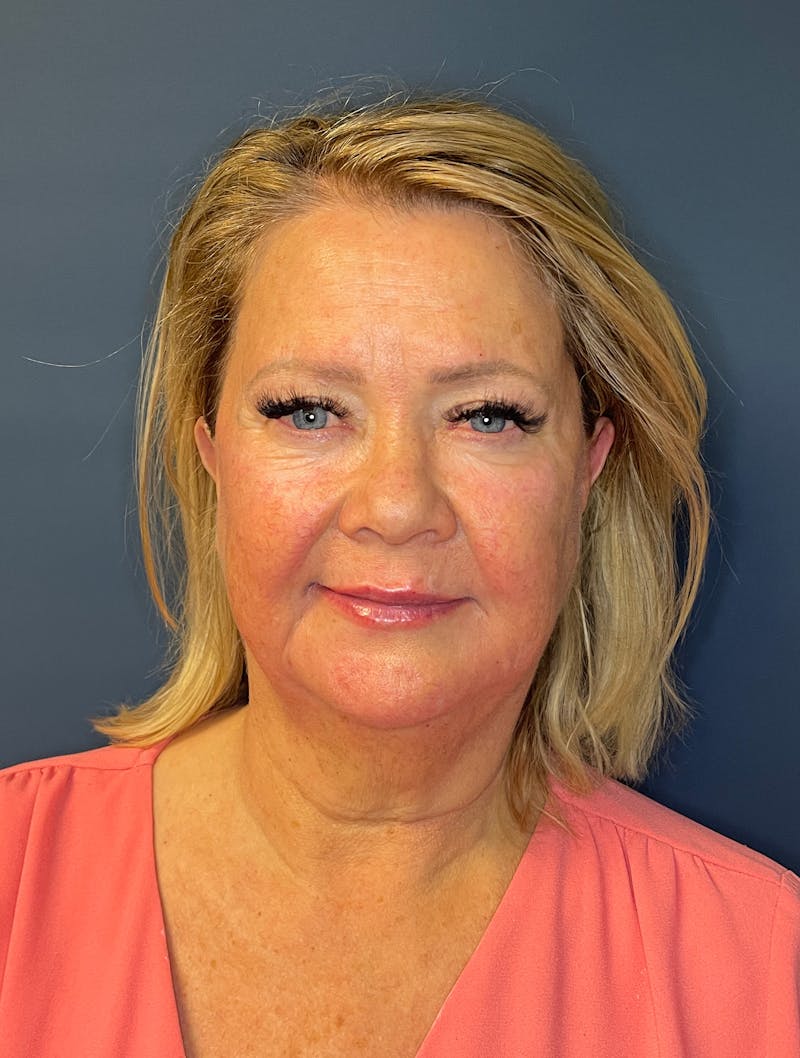 Facial Fillers Before & After Gallery - Patient 380456 - Image 2