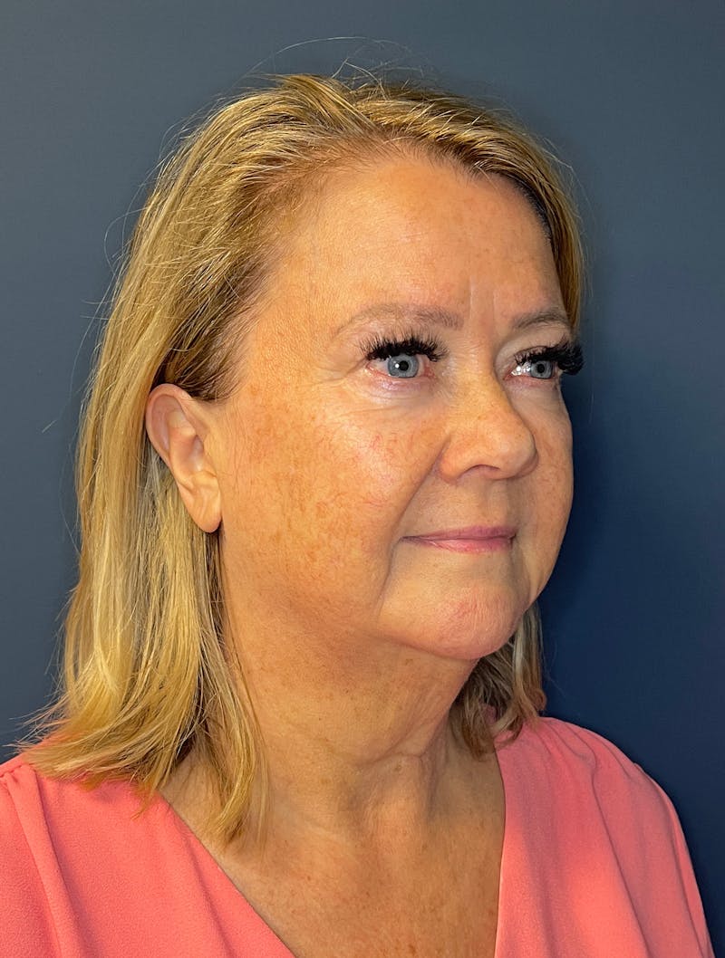 Facial Fillers Before & After Gallery - Patient 380456 - Image 5