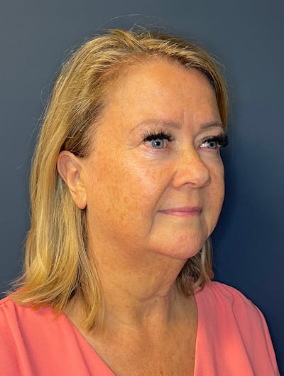 Facial Fillers Before & After Gallery - Patient 380456 - Image 5