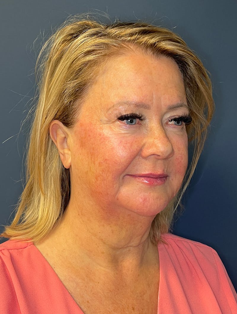 Facial Fillers Before & After Gallery - Patient 380456 - Image 6