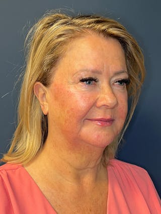 Facial Fillers Before & After Gallery - Patient 380456 - Image 6