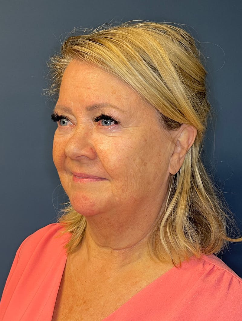 Facial Fillers Before & After Gallery - Patient 380456 - Image 3