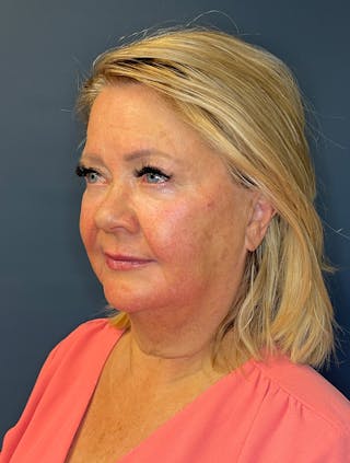 Facial Fillers Before & After Gallery - Patient 380456 - Image 4