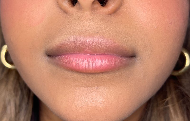 Facial Fillers Before & After Gallery - Patient 278787 - Image 1