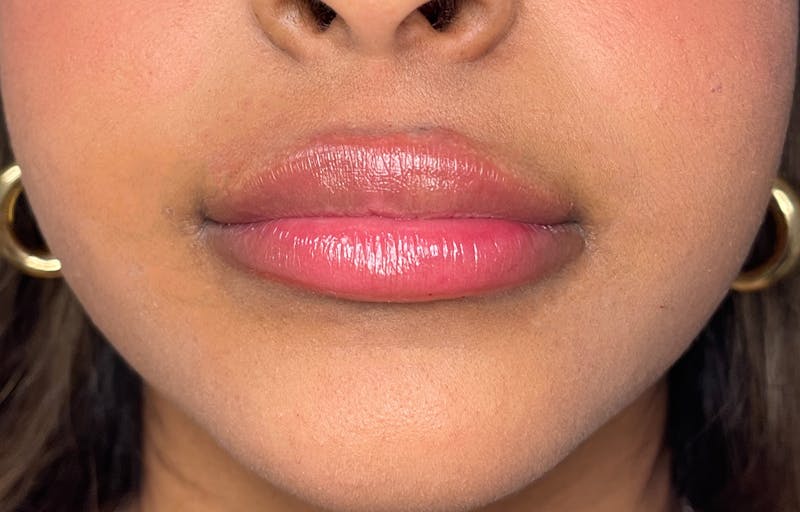 Facial Fillers Before & After Gallery - Patient 278787 - Image 2