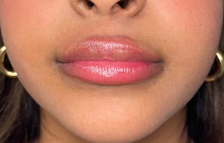 Facial Fillers Before & After Gallery - Patient 278787 - Image 2