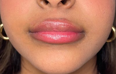 Facial Fillers Before & After Gallery - Patient 278787 - Image 2