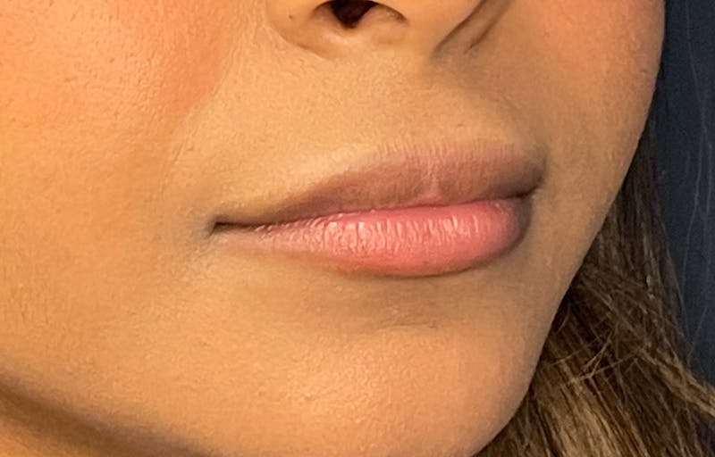 Facial Fillers Before & After Gallery - Patient 278787 - Image 3