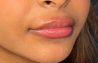 Facial Fillers Before & After Gallery - Patient 278787 - Image 4