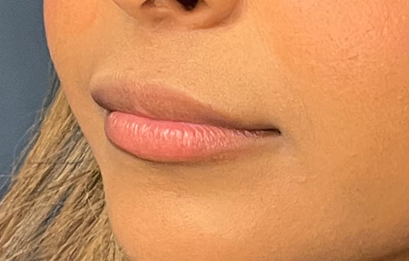 Facial Fillers Before & After Gallery - Patient 278787 - Image 5