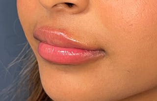 Facial Fillers Before & After Gallery - Patient 278787 - Image 6