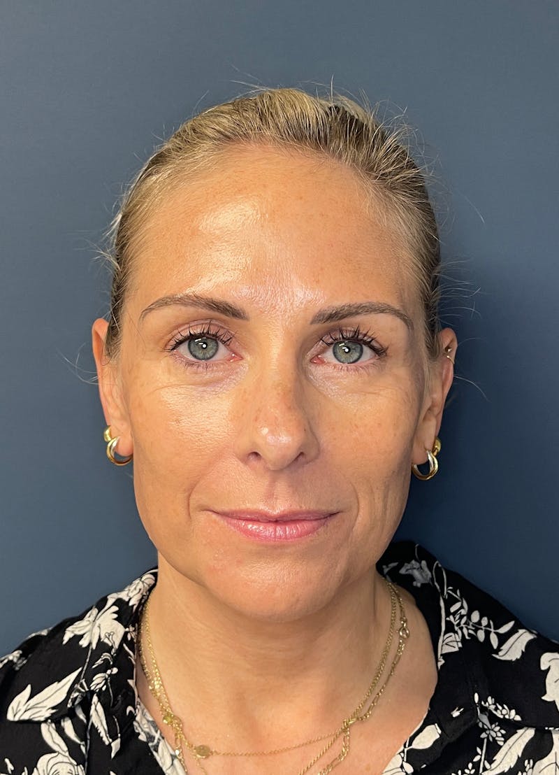 Facial Fillers Before & After Gallery - Patient 150994 - Image 1
