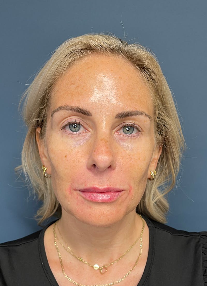 Facial Fillers Before & After Gallery - Patient 150994 - Image 2