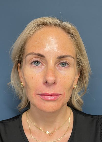 Facial Fillers Before & After Gallery - Patient 150994 - Image 2