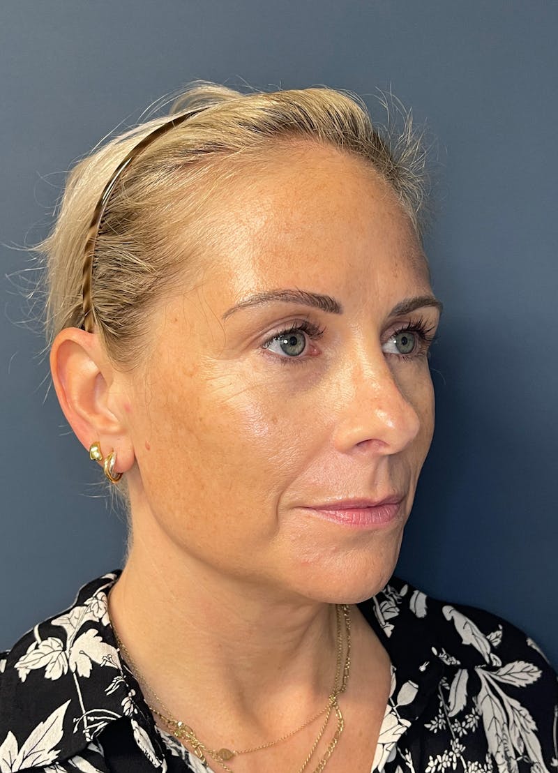 Facial Fillers Before & After Gallery - Patient 150994 - Image 3