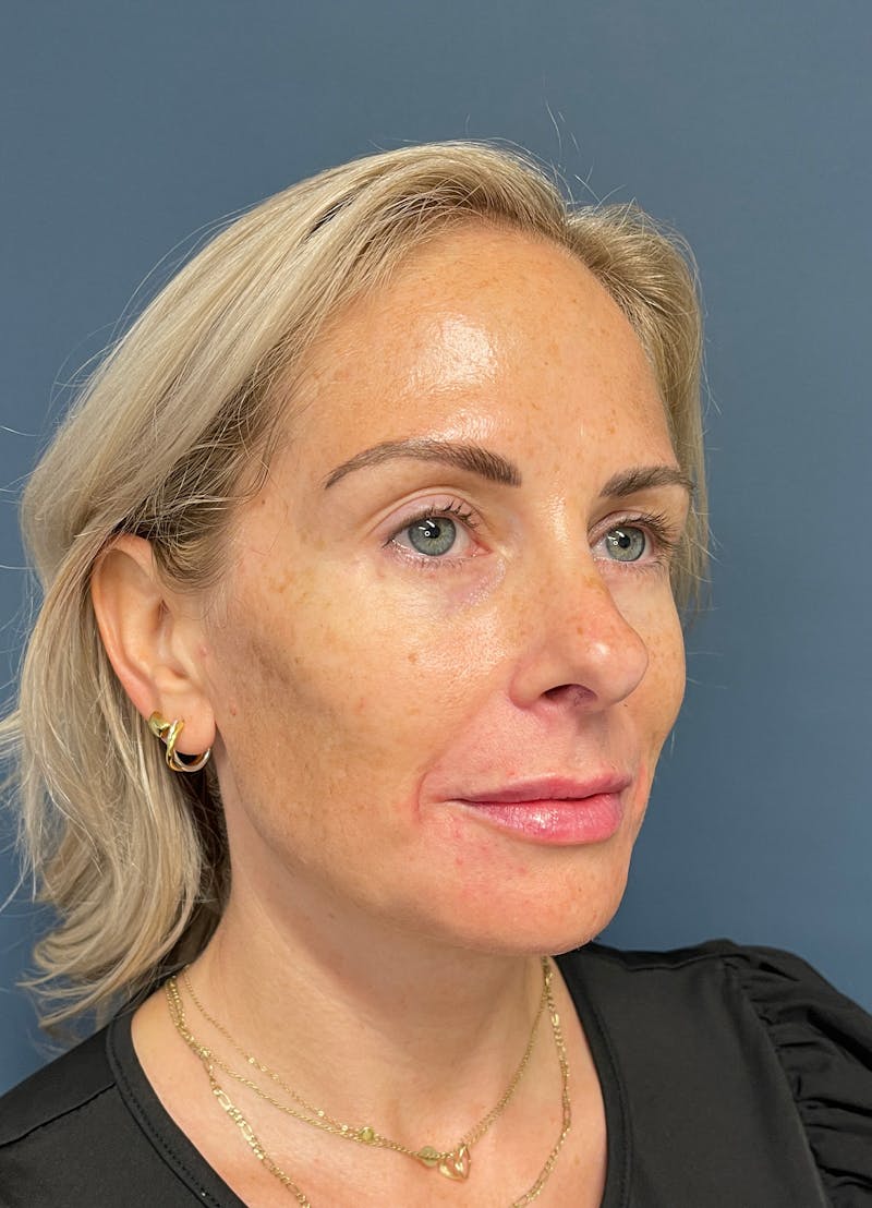Facial Fillers Before & After Gallery - Patient 150994 - Image 4