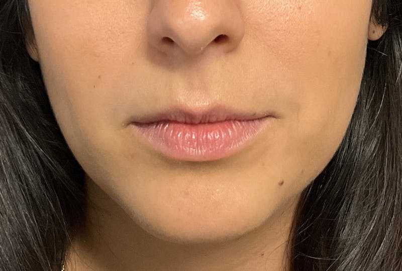 Facial Fillers Before & After Gallery - Patient 248479 - Image 1