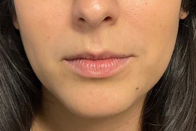 Facial Fillers Before & After Gallery - Patient 248479 - Image 1