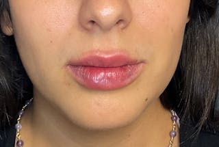 Facial Fillers Before & After Gallery - Patient 248479 - Image 2