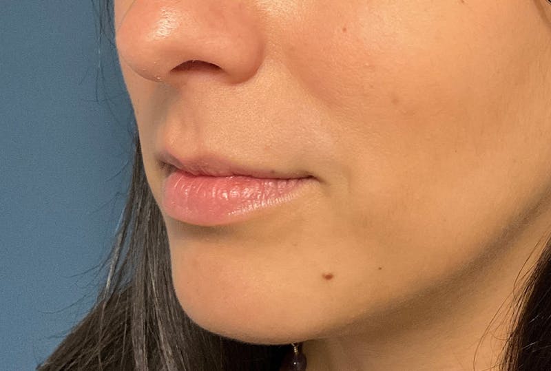 Facial Fillers Before & After Gallery - Patient 248479 - Image 5