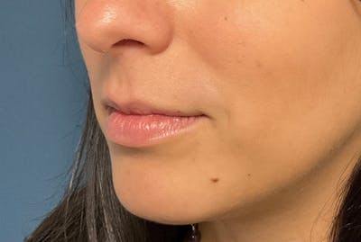 Facial Fillers Before & After Gallery - Patient 248479 - Image 5