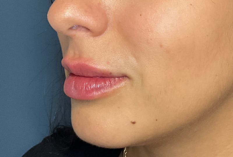 Facial Fillers Before & After Gallery - Patient 248479 - Image 6