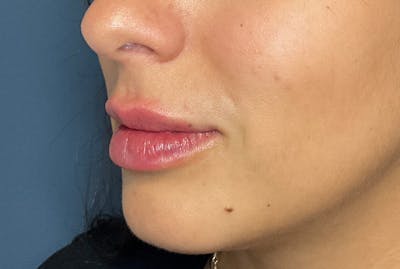 Facial Fillers Before & After Gallery - Patient 248479 - Image 6