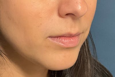 Facial Fillers Before & After Gallery - Patient 248479 - Image 3