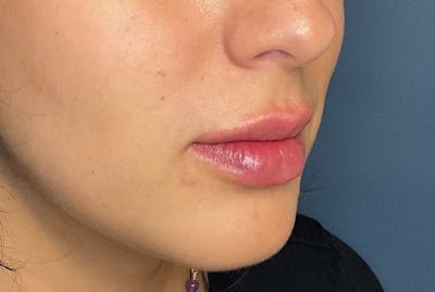 Facial Fillers Before & After Gallery - Patient 248479 - Image 4