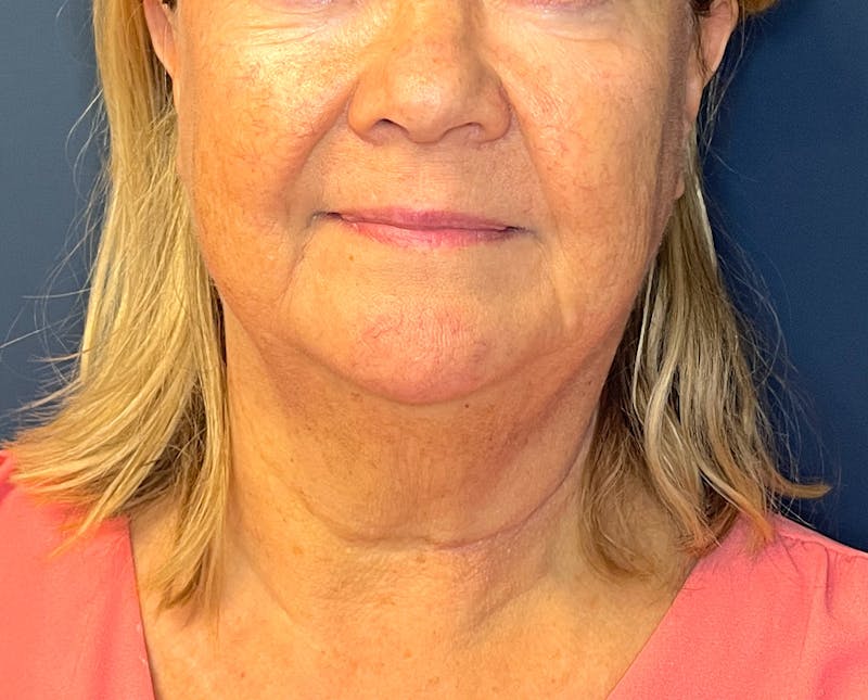 Morpheus8 Before & After Gallery - Patient 412696 - Image 1