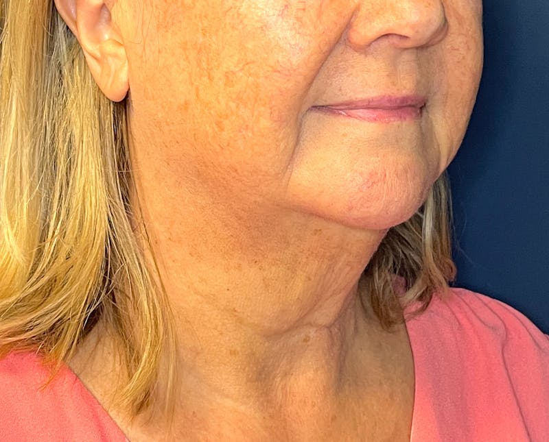 Morpheus8 Before & After Gallery - Patient 412696 - Image 3