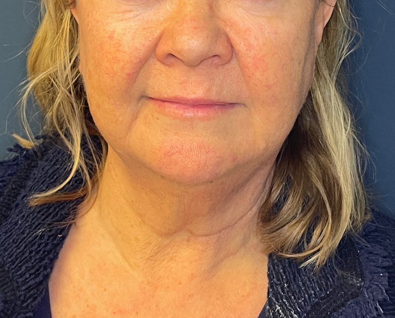 Morpheus8 Before & After Gallery - Patient 412696 - Image 2