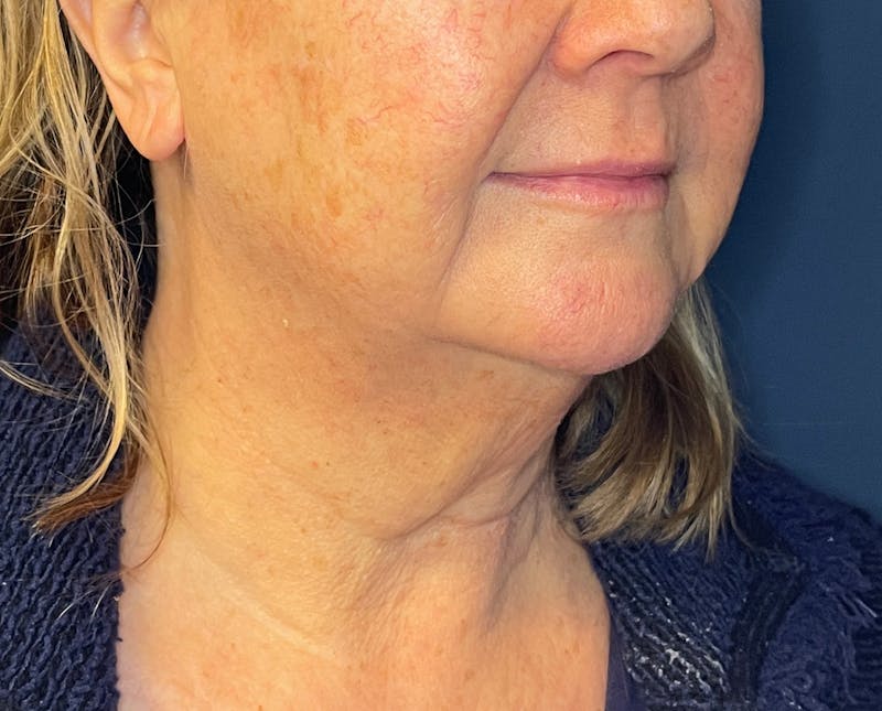 Morpheus8 Before & After Gallery - Patient 412696 - Image 4