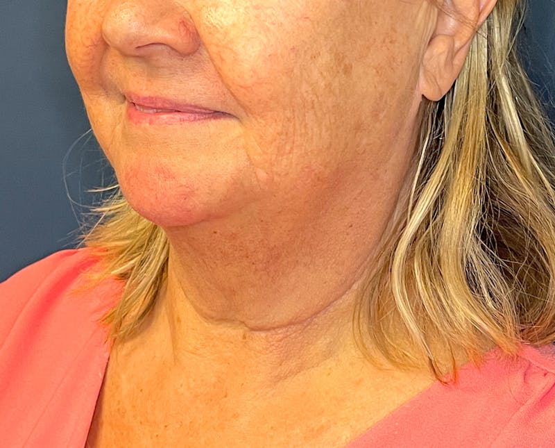 Morpheus8 Before & After Gallery - Patient 412696 - Image 5