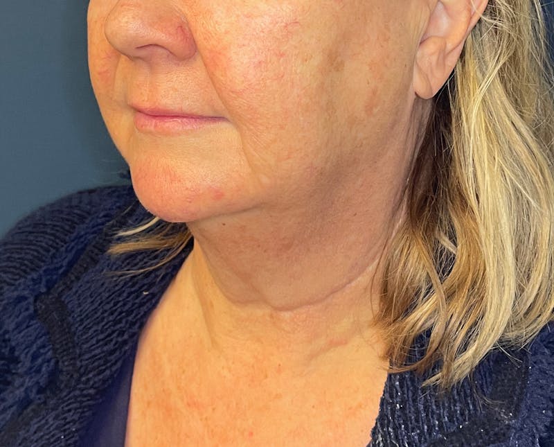 Morpheus8 Before & After Gallery - Patient 412696 - Image 6