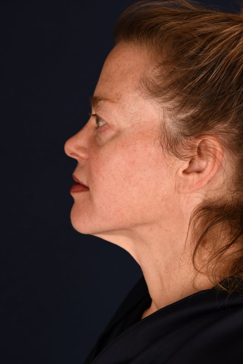 Facelift Before & After Gallery - Patient 9698374 - Image 9