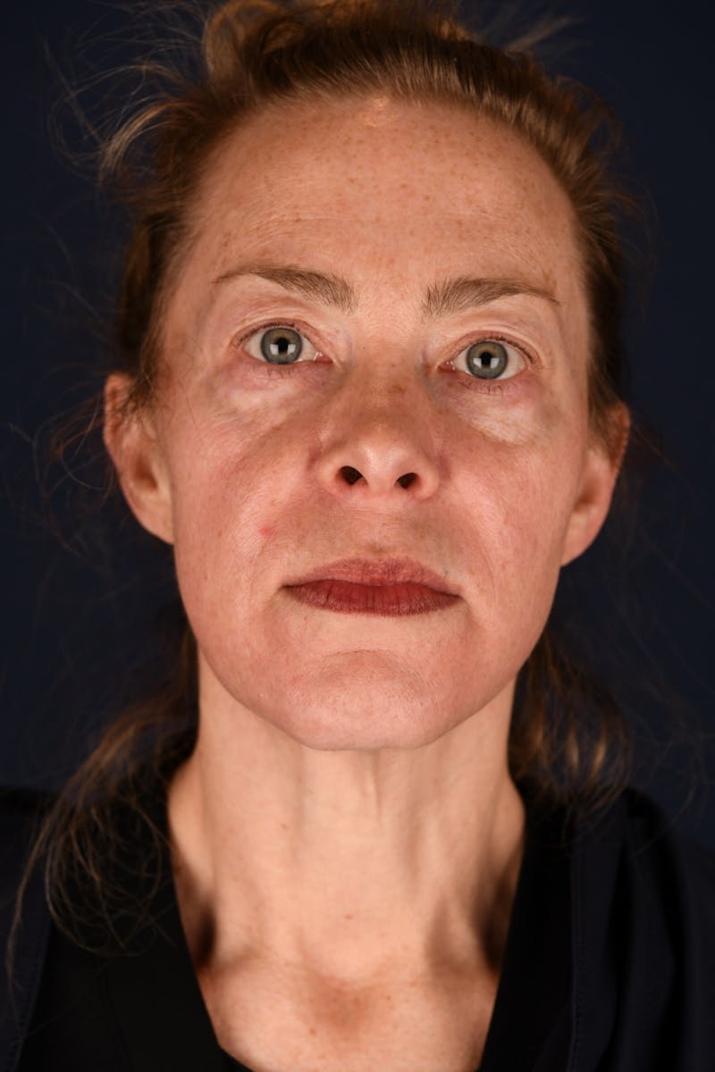 Facelift Before & After Gallery - Patient 9698374 - Image 1