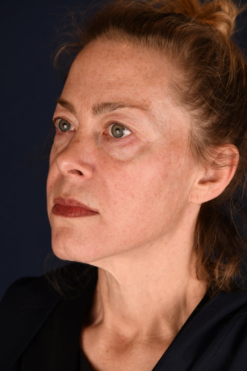 Facelift Before & After Gallery - Patient 9698374 - Image 7