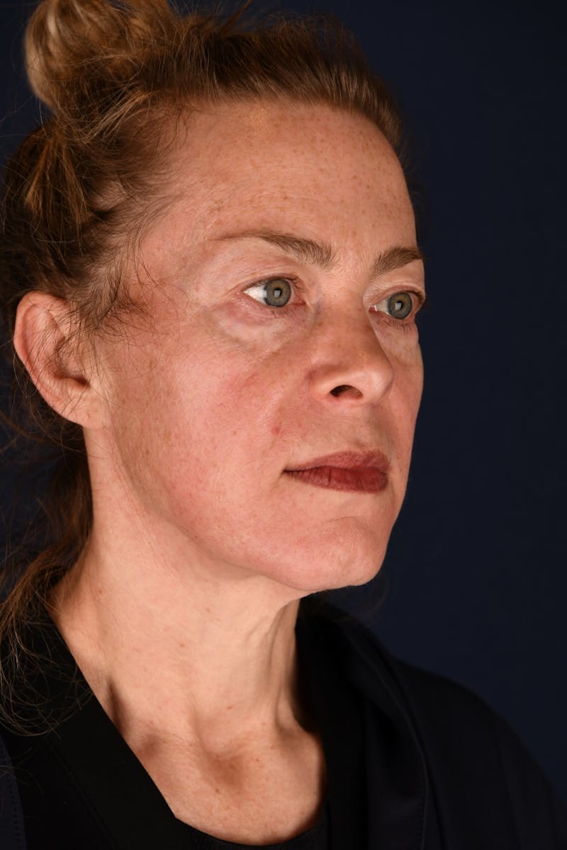 Facelift Before & After Gallery - Patient 9698374 - Image 3