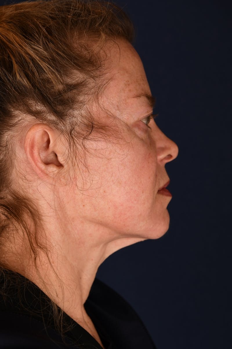 Facelift Before & After Gallery - Patient 9698374 - Image 5