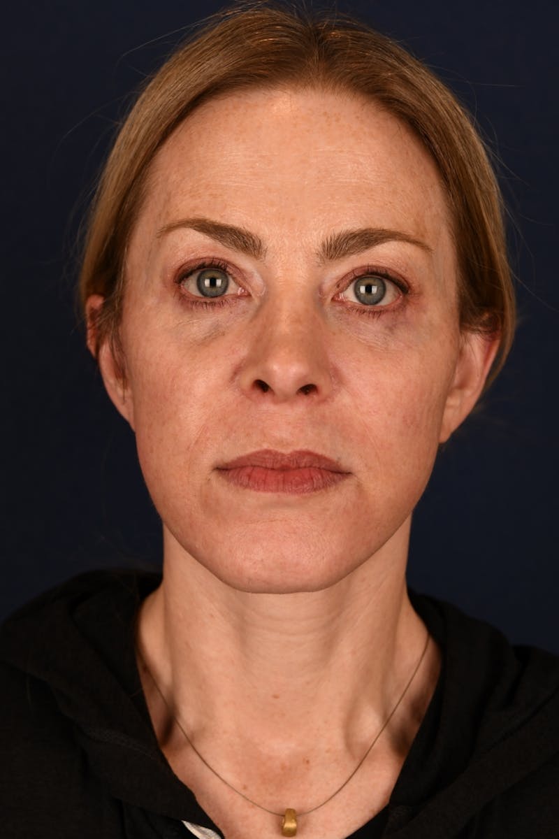 Facelift Before & After Gallery - Patient 9698374 - Image 2