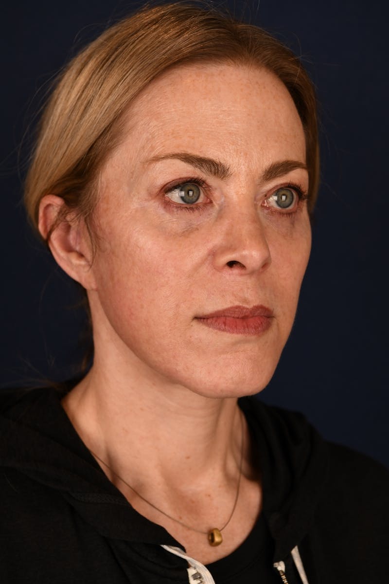 Facelift Before & After Gallery - Patient 9698374 - Image 4