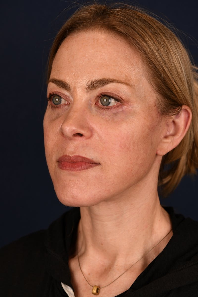 Facelift Before & After Gallery - Patient 9698374 - Image 8